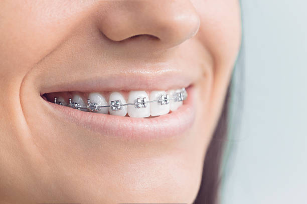 Best Traditional Braces  in Toppers, OK